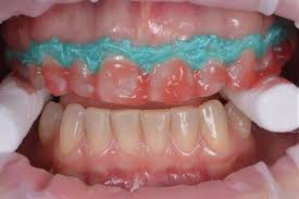 Traditional Whitening Methods