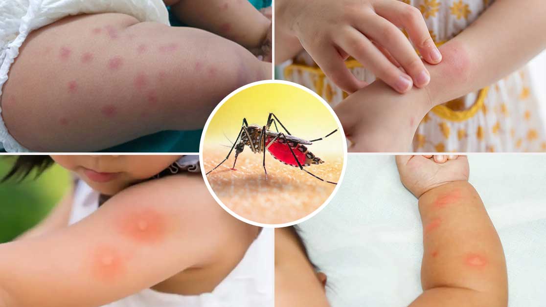 Severe mosquito bites on children